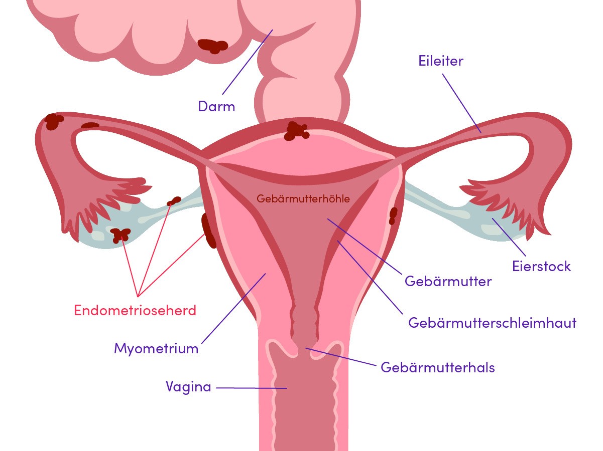 DE Endometriose Diagramm